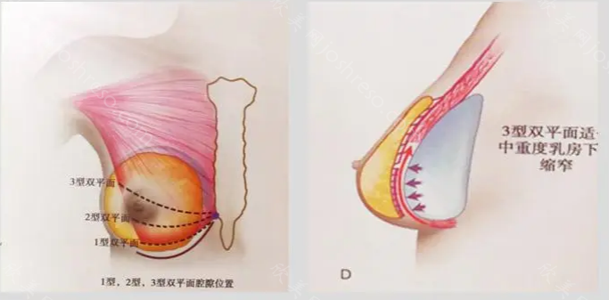 乳房下垂矫正前后对比效果图