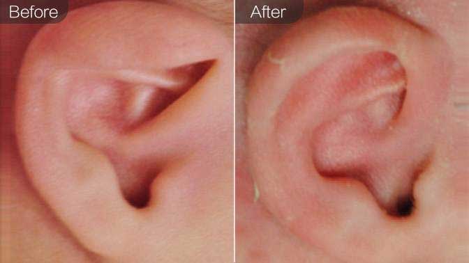 副耳去除术前后效果对比图
