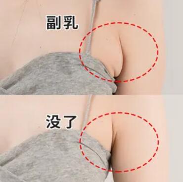 手术去副乳前后效果对比图