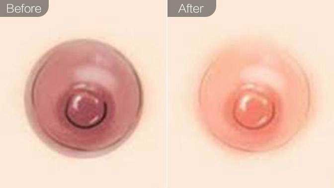 乳晕漂红效果图