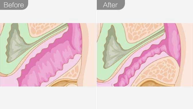 激光私密紧致前后效果对比图