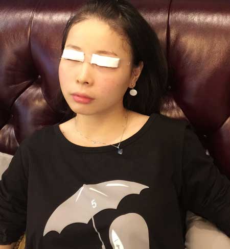 上海九院顾钏给我做全切双眼皮手术