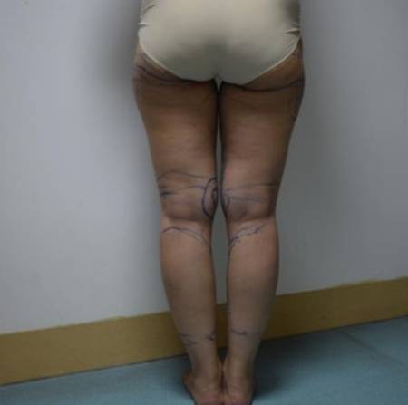 成都中科美美给我做的吸脂瘦大腿手术前