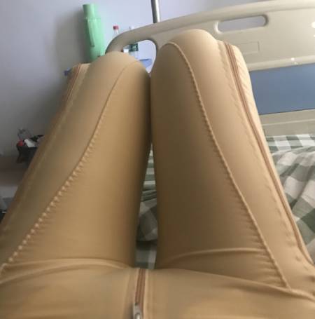 成都中科美美给我做的吸脂瘦大腿手术后1天
