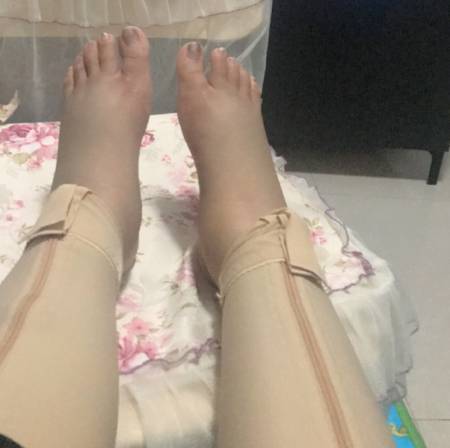 成都中科美美给我做的吸脂瘦大腿手术后7天