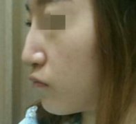 成都正好医学美容医院王春敏怎么样？个人简历|鹰钩鼻矫正真实分享~