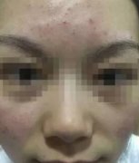 看我在广州市佳人医疗美容门诊部做点阵激光祛痘，还我光滑白皙皮肤，不留疤
