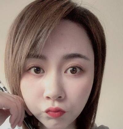 在广州韩妃医学美容医院做了自体脂肪面部填充手术后40天