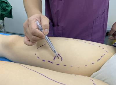 去广州积美找福田庆三做吸脂瘦大腿手术后