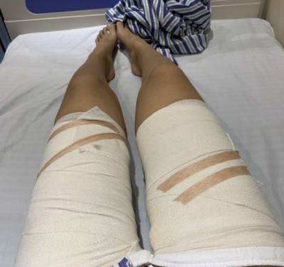 去广州积美找福田庆三做吸脂瘦大腿手术后3天