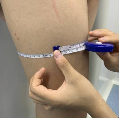 去广州积美找福田庆三做吸脂瘦大腿手术后25天