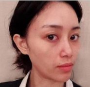 阮正泉吸脂怎么样？阮医生信息揭秘！附自体脂肪填充手术真实案例反馈~