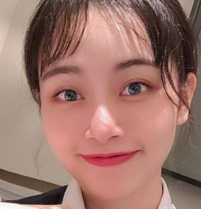 在南方医科大学珠江整形医院做的自体脂肪面部填充手术后90天