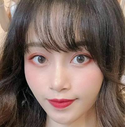 在南方医科大学珠江整形医院做的自体脂肪面部填充手术后120天