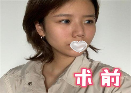 上海九院张路隆鼻怎么样?隆鼻顾客反馈对比图
