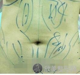 成都蓉美和谐医疗美容门诊部王自谦做吸脂怎么样?附吸脂案例