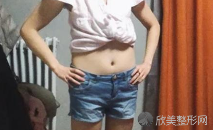 成都蓉美和谐医疗美容门诊部王自谦做吸脂怎么样?附吸脂案例