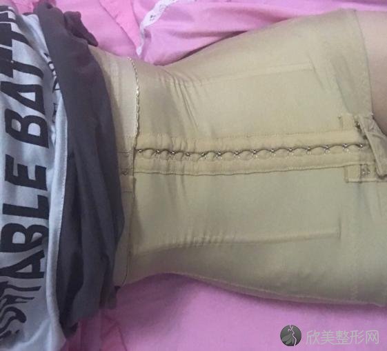 成都蓉美和谐医疗美容门诊部王自谦做吸脂怎么样?附吸脂案例