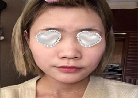 上海九院祝联鼻翼做得好吗?吸脂顾客反馈案例-收费标准