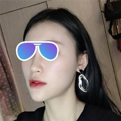 北医三院李东隆鼻怎么样?自体脂肪面部填充三个月术前术后图-价格表更新