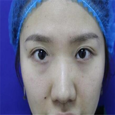 上海华山医院周兆平眼袋手术?双眼皮案例和价格同步分享！