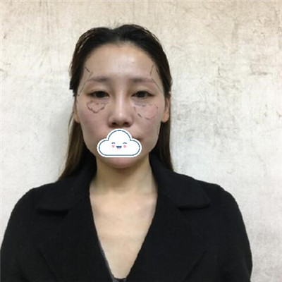 北京华韩柳民熙面部提升做得好吗?自体脂肪填充三个月术前术后图-价格表
