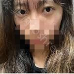 长春汇美国际整形医院到底怎么样?内附案例分享+2021较新价格表