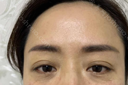 做完眶隔释放去眼袋，让我变得更自信了！