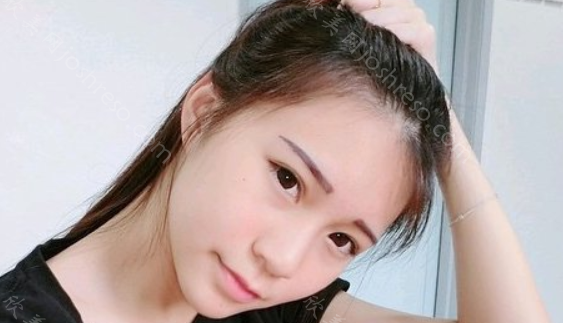 做完眶隔释放去眼袋，让我变得更自信了！