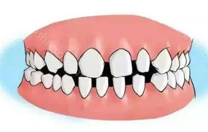 牙齿稀疏手术需要注意什么？