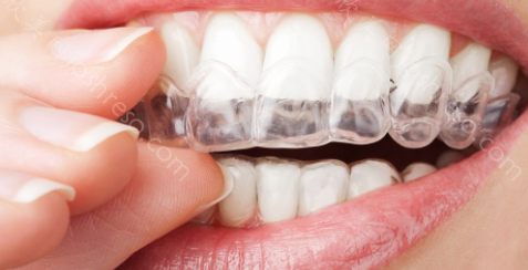 牙齿稀疏矫正方式是什么？