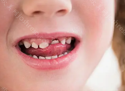 牙齿松动的原因有哪些？