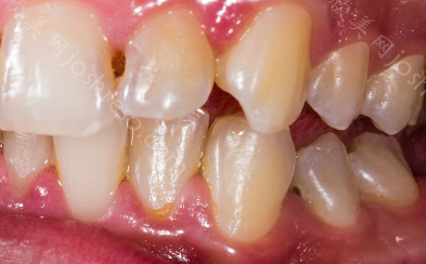 六大治疗原则帮您摆脱慢性牙周炎