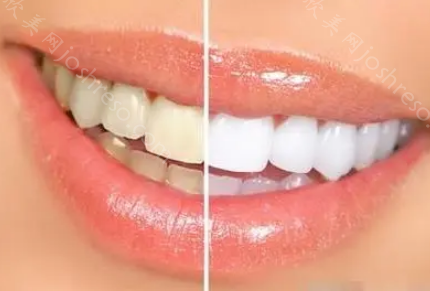 牙齿发黄变白有哪些方法？一起来看看吧