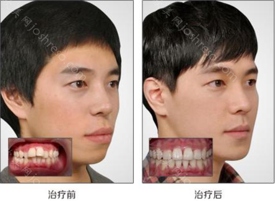 牙齿矫正前后效果对比图