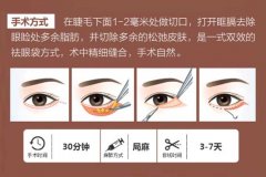 详解外切去眼袋恢复期