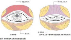 矫正上睑下垂的3种主流方式