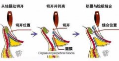 下睑下至术手术步骤(过程详解)