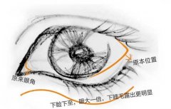下眼睑下至手术的好处