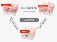 激光去除黑眼圈有用吗?为什么更黑?