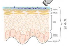 玻尿酸去黑眼圈的全过程