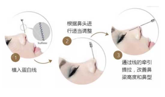 线雕隆鼻到底能不能做 为什么有的医生不建议做 欣美整形