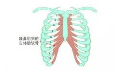 自体肋软骨隆鼻术多少钱