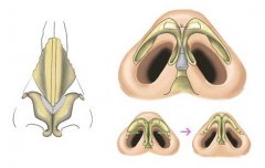 缩鼻翼手术多少钱?费用是多少?
