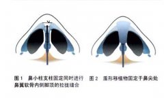 鼻小柱延长手术常用哪种切口