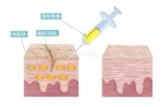 自体脂肪可以填充鼻基底吗