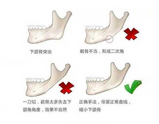 下颌角磨骨有哪几种方法