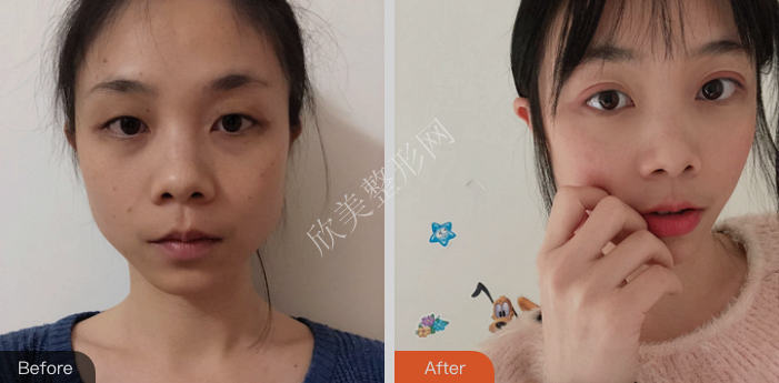成都美莱医院怎么样 成都美莱做双眼皮技术好吗 案例 价格 欣美整形 成都美莱医院怎么样 成都美莱做双眼皮技术好吗 案例 价格 欣美整形