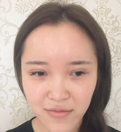 上海喜美医疗美容鼻部修复案例