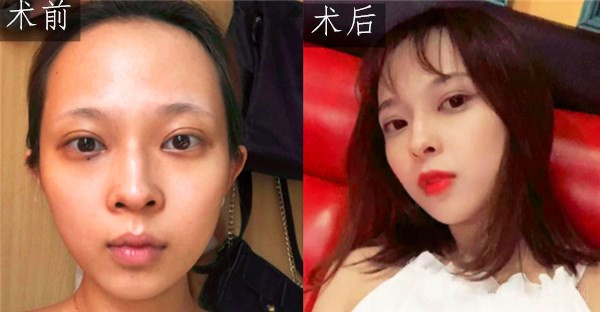 张效恩成功案例分享：术前术后对比图